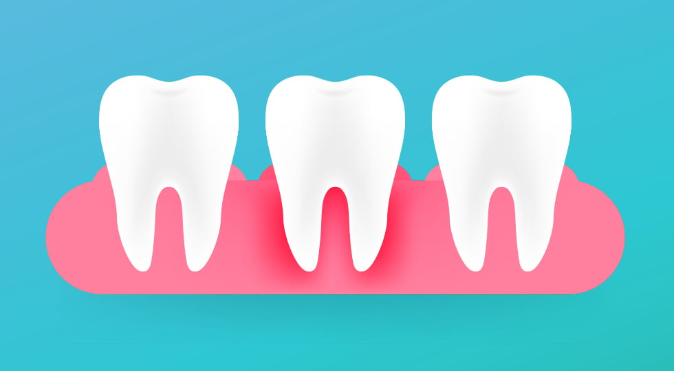 เหงือกบวม ปวดฟัน เกิดจากอะไร รักษาอย่างไร ? | Listerine® Anti-Bacterial  Mouthwash ผลิตภัณฑ์น้ำยาบ้วนปากและดูแลช่องปาก